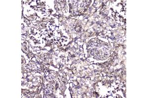 IHC testing of FFPE human rectal cancer tissue with S100A10 antibody at 1ug/ml. (S100A10 抗体)