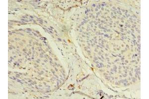 Immunohistochemistry of paraffin-embedded human cervical cancer using ABIN7160712 at dilution of 1:100 (NAT8 抗体  (AA 64-227))