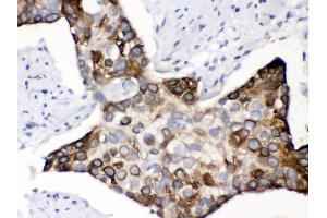 Anti- KIN Picoband antibody, IHC(P) IHC(P): Human Oesophagus Squama Cancer Tissue (KIN 抗体  (AA 3-202))