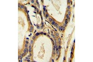 CCL4 antibody immunohistochemistry analysis in formalin fixed and paraffin embedded human prostate carcinoma. (CCL4 抗体  (AA 22-48))