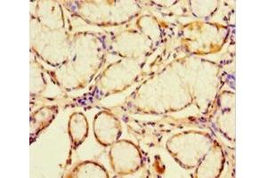 Immunohistochemistry of paraffin-embedded human gastric cancer using ABIN7147035 at dilution of 1:100 (CATSPER4 抗体  (AA 306-472))