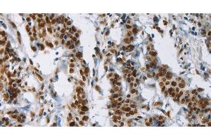 Immunohistochemistry of paraffin-embedded Human gastic cancer using IL17C Polyclonal Antibody at dilution of 1:50 (IL17C 抗体)
