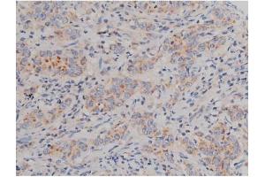 ABIN6267496 at 1/200 staining Human ganstric cancer tissue sections by IHC-P. (SNCA 抗体  (pSer129))