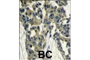 Formalin-fixed and paraffin-embedded human breast carcinoma reacted with GBL antibody (Center), which was peroxidase-conjugated to the secondary antibody, followed by DAB staining. (GBL 抗体  (AA 140-170))