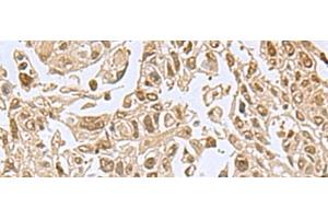 Immunohistochemistry of paraffin-embedded Human lung cancer tissue using NVL Polyclonal Antibody at dilution of 1:80(x200) (NVL 抗体)