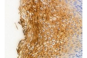 ABIN6256276 and ABIN6267430 at 1/100 staining human cervical carcinoma by IHC-P.