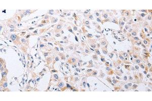 Immunohistochemistry of paraffin-embedded Human lung cancer tissue using SERP1 Polyclonal Antibody at dilution 1:30 (SERP1 抗体)
