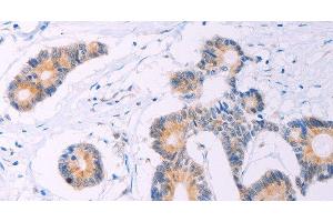 Immunohistochemistry of paraffin-embedded Human colon cancer tissue using ADCY5 Polyclonal Antibody at dilution 1:30 (ADCY5 抗体)
