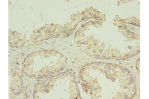 Immunohistochemistry of paraffin-embedded human prostate cancer using ABIN7173059 at dilution of 1:100 (TMEM141 抗体  (AA 1-108))
