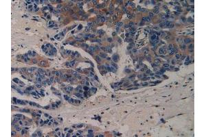 IHC-P analysis of Human Breast Cancer Tissue, with DAB staining. (VEGFR2/CD309 抗体  (AA 46-320))