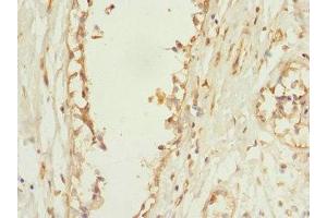 Immunohistochemistry of paraffin-embedded human breast cancer using ABIN7163649 at dilution of 1:100 (PLEKHF2 抗体  (AA 1-249))