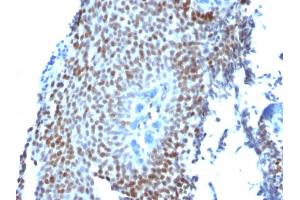 Formalin-fixed, paraffin-embedded human Bladder Carcinoma stained with p21 Mouse Monoclonal Antibody (CIP1/823). (p21 抗体)