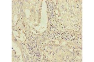 Immunohistochemistry of paraffin-embedded human lung cancer using ABIN7163315 at dilution of 1:100