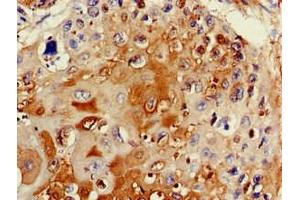 Immunohistochemistry of paraffin-embedded human cervical cancer using ABIN7171915 at dilution of 1:100 (TTC19 抗体  (AA 108-380))