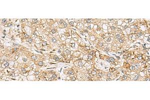Immunohistochemistry of paraffin-embedded Human liver cancer tissue using SH3GL2 Polyclonal Antibody at dilution of 1:80(x200) (SH3G2 抗体)
