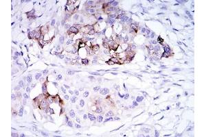 Immunohistochemical analysis of paraffin-embedded mammary cancer tissues using SCGB2A2 antibody with DAB staining. (Mammaglobin A 抗体)