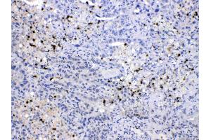 NEDD8 was detected in paraffin-embedded sections of human lung cancer tissues using rabbit anti- NEDD8 Antigen Affinity purified polyclonal antibody (Catalog # ) at 1 µg/mL.