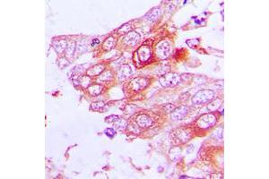 Immunohistochemical analysis of MUC13 staining in human lung cancer formalin fixed paraffin embedded tissue section. (MUC13 抗体  (C-Term))