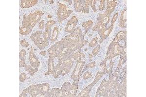 IHC analysis of Cytokeratin 19 using anti-Cytokeratin 19 antibody (ABIN3043288). (Cytokeratin 19 抗体  (C-Term))