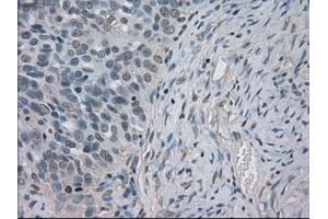 Immunohistochemical staining of paraffin-embedded Adenocarcinoma of ovary tissue using anti-SLC2A5mouse monoclonal antibody. (SLC2A5 抗体)