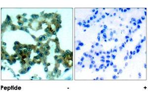 Immunohistochemical analysis of paraffin-embedded human lung carcinoma tissue using PRKCB polyclonal antibody . (PKC beta 抗体)