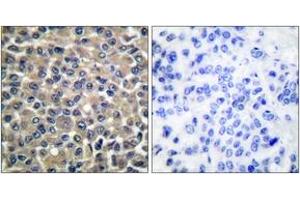 Immunohistochemistry analysis of paraffin-embedded human breast carcinoma tissue, using MMP-19 Antibody. (MMP19 抗体  (AA 11-60))