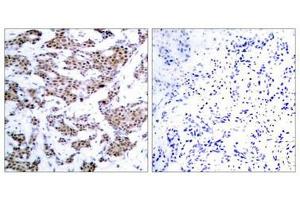 Immunohistochemical analysis of paraffin-embedded human breast carcinoma tissue using MEF2A(Phospho-Thr312) Antibody(left) or the same antibody preincubated with blocking peptide(right). (MEF2A 抗体  (pThr312))