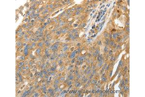 Immunohistochemistry of Human ovarian cancer using CALR Polyclonal Antibody at dilution of 1:50 (Calreticulin 抗体)