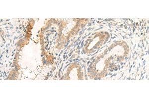 Immunohistochemistry of paraffin-embedded Human cervical cancer tissue using GPR89A/GPR89B Polyclonal Antibody at dilution of 1:25(x200) (GPR89A 抗体)