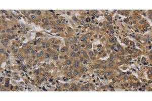 Immunohistochemistry of paraffin-embedded Human liver cancer tissue using KIF4A Polyclonal Antibody at dilution 1:40 (KIF4A 抗体)