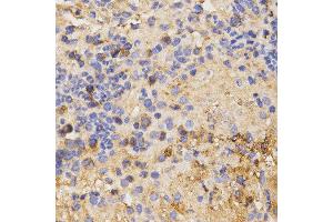 Immunohistochemistry of paraffin-embedded mouse liver fibrosis tissue using CSF2RA antibody at dilution of 1:200 (x400 lens) (CSF2RA 抗体)