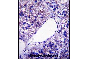 PNPLA4 Antibody (C-term) (ABIN657892 and ABIN2846844) immunohistochemistry analysis in formalin fixed and paraffin embedded human hepatocarcinoma followed by peroxidase conjugation of the secondary antibody and DAB staining. (PNPLA4 抗体  (C-Term))