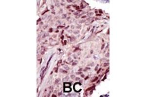 Formalin-fixed and paraffin-embedded human cancer tissue reacted with the primary antibody, which was peroxidase-conjugated to the secondary antibody, followed by DAB staining. (IRAK4 抗体  (N-Term))