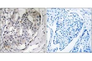 Immunohistochemistry analysis of paraffin-embedded human breast carcinoma, using DARPP-32 (Phospho-Thr75) Antibody. (DARPP32 抗体  (pThr75))