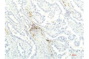 Immunohistochemical analysis of paraffin-embedded Human Lung Carcinoma Tissue using JAK1 Mouse mAb diluted at 1:200. (JAK1 抗体  (AA 960-1040))