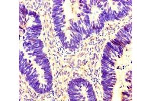 Immunohistochemistry of paraffin-embedded human ovarian cancer using ABIN7142095 at dilution of 1:100 (14-3-3 gamma 抗体  (AA 113-194))