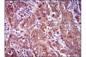 Immunohistochemical analysis of paraffin-embedded endometrial cancer tissues using CLGN mouse mAb with DAB staining. (Calmegin 抗体  (AA 249-405))