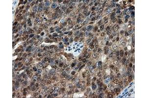 Immunohistochemical staining of paraffin-embedded Adenocarcinoma of colon tissue using anti-CUGBP1 mouse monoclonal antibody. (CELF1 抗体)