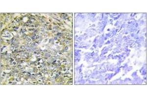 Immunohistochemistry analysis of paraffin-embedded human lung carcinoma tissue, using UBXD5 Antibody. (UBXN11 抗体  (AA 131-180))