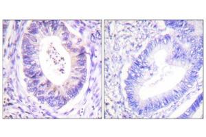 Immunohistochemistry analysis of paraffin-embedded human colon carcinoma tissue using p90 RSK (epitope around residue 573) antibody. (RPS6KA3 抗体  (Thr573))
