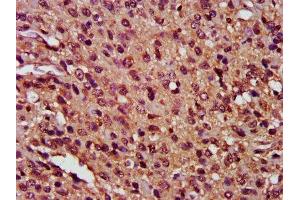 IHC image of ABIN7146901 diluted at 1:400 and staining in paraffin-embedded human glioma performed on a Leica BondTM system. (FLIP 抗体  (AA 1-250))