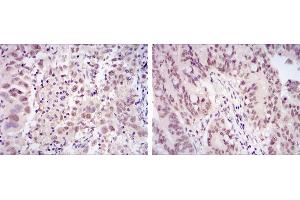 Immunohistochemical analysis of paraffin-embedded endometrial cancer tissues (left) and rectum cancer tissues (right) using CDK9 mouse mAb with DAB staining. (CDK9 抗体)