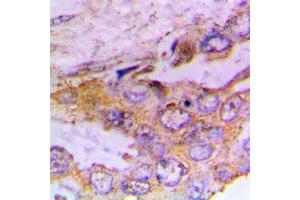Immunohistochemical analysis of CaMK1 alpha (pT177) staining in human lung cancer formalin fixed paraffin embedded tissue section. (CAMK1 抗体  (pSer177))