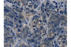 IHC-P analysis of Human Thyroid cancer Tissue, with DAB staining. (Tyrosine Hydroxylase 抗体  (AA 82-310))