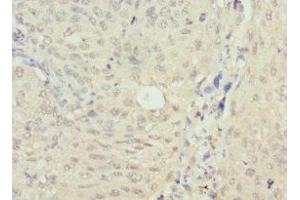 Immunohistochemistry of paraffin-embedded human lung cancer using ABIN7161740 at dilution of 1:100 (NSFL1C 抗体  (AA 1-185))