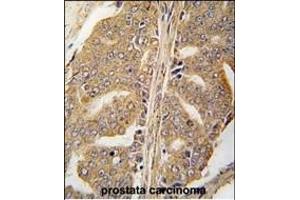 Formalin-fixed and paraffin-embedded human prostata carcinoma tissue reacted with PXN Antibody  (ABIN390376 and ABIN2840778) , which was peroxidase-conjugated to the secondary antibody, followed by DAB staining. (Paxillin 抗体  (AA 94-125))