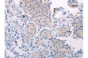 The image on the left is immunohistochemistry of paraffin-embedded Human lung cancer tissue using ABIN7131321(TEKT4 Antibody) at dilution 1/10, on the right is treated with fusion protein. (Tektin 4 抗体)