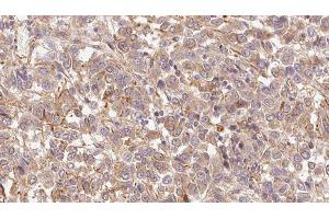 ABIN6279482 at 1/100 staining Human Melanoma tissue by IHC-P.