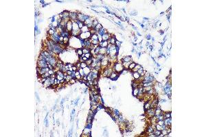 Immunohistochemistry of paraffin-embedded Human colon carcinoma using [KO Validated] CHCHD2 Rabbit pAb (ABIN7266448) at dilution of 1:100 (40x lens). (CHCHD2 抗体  (AA 75-145))