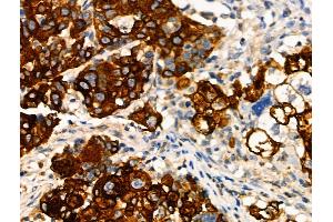 Phospho-MAP3K8/COT (Ser443) Antibody at 1/100 staining Human ovarian cancer by IHC-P. (MAP3K8 抗体  (pSer443))